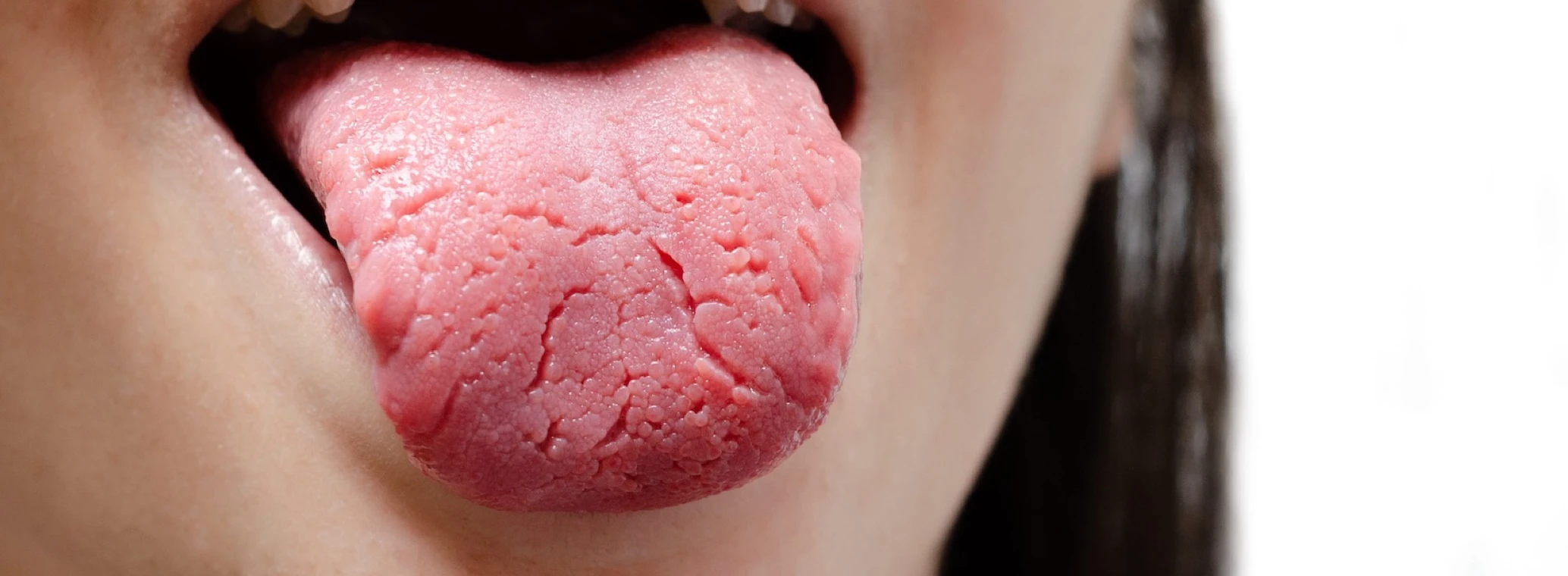  Image of cracked tongue stuck out person’s mouth 