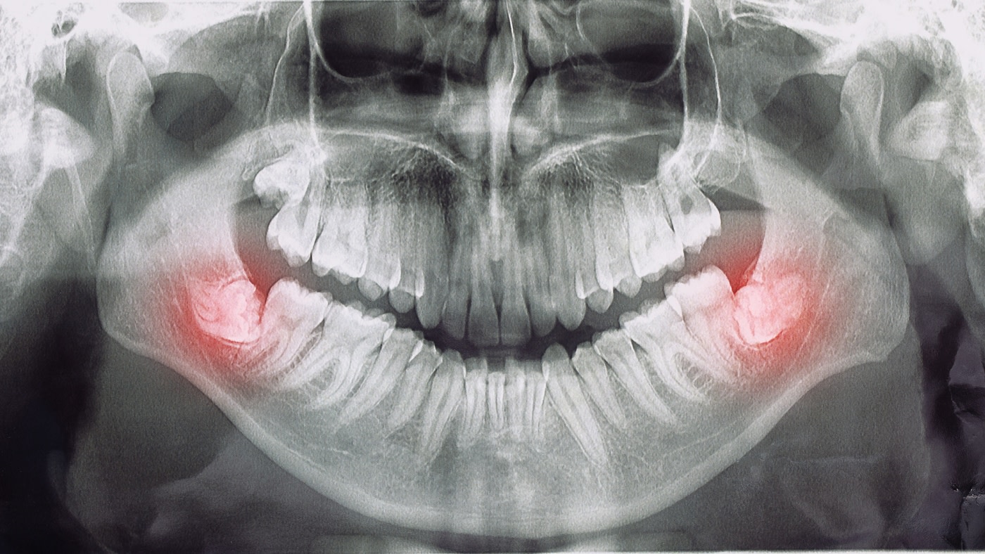 impacted wisdom teeth