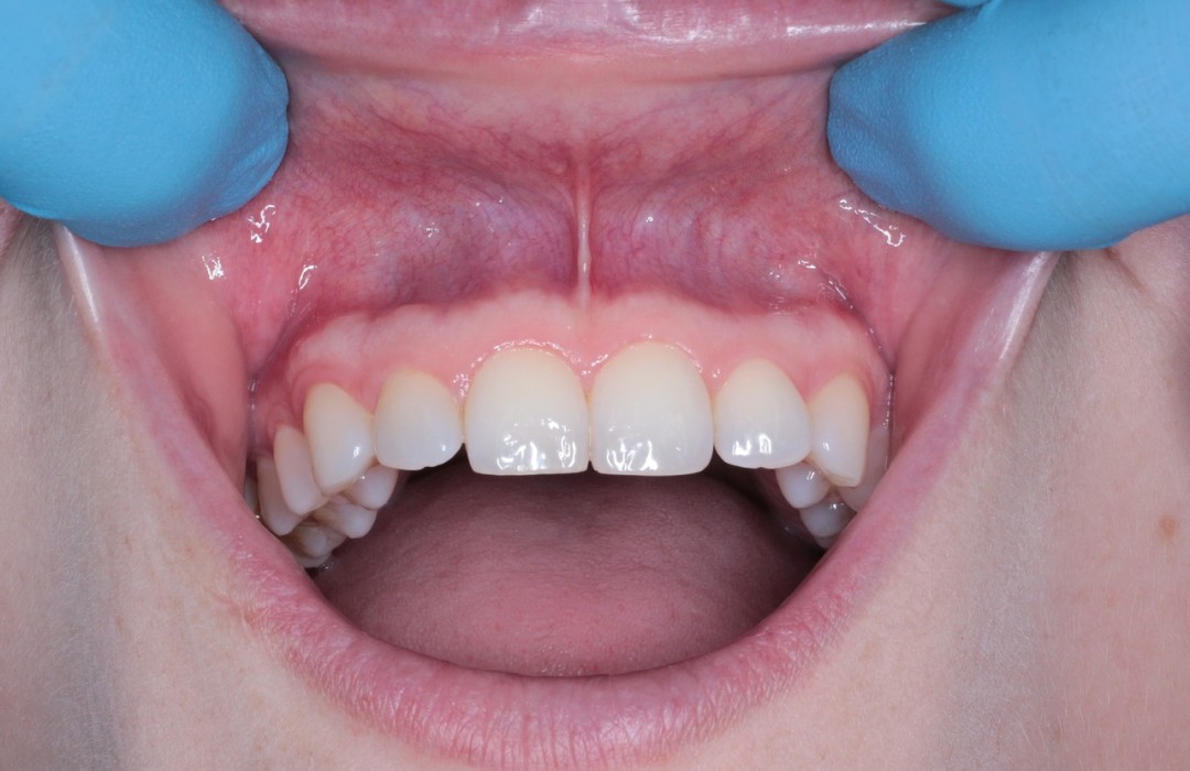 hereditary gingival fibromatosis