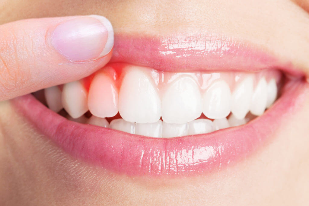 Top 5 Vitamins For Gum Health Vdm Dental Blog Ny 10014