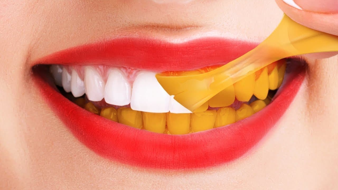 Why Teeth Turn Yellow In Adults And Children Vdm Dental Blog Ny 10014