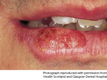 tobacco mouth cancer pictures Pictures Of Mouth Cancer
