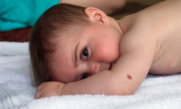 Taches de naissance: hémangiomes sur bébé | Pampers FR