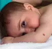 Tache de naissance sur un bébé