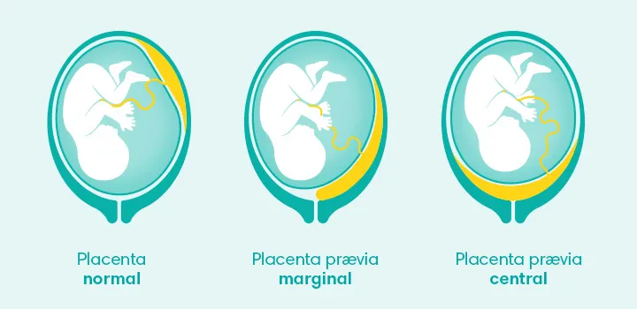 Les différents types de placenta prævia