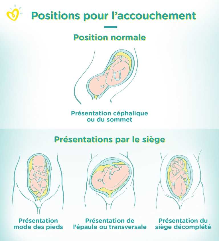 Accouchement Par Le Siege Causes Et Consequences Pampers