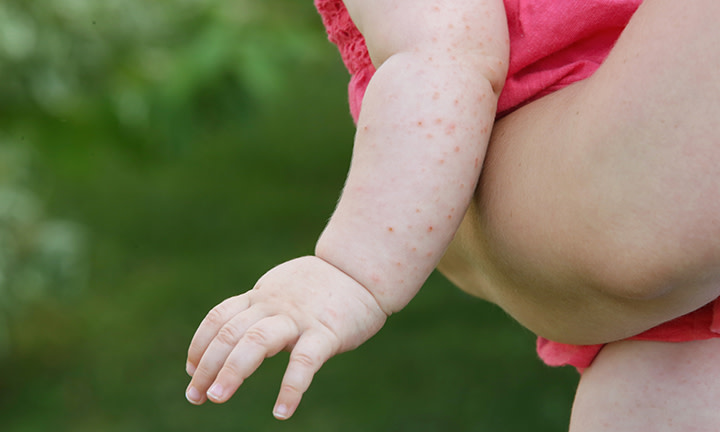 Bouton De Chaleur Bebe Causes Traitement Pampers Fr