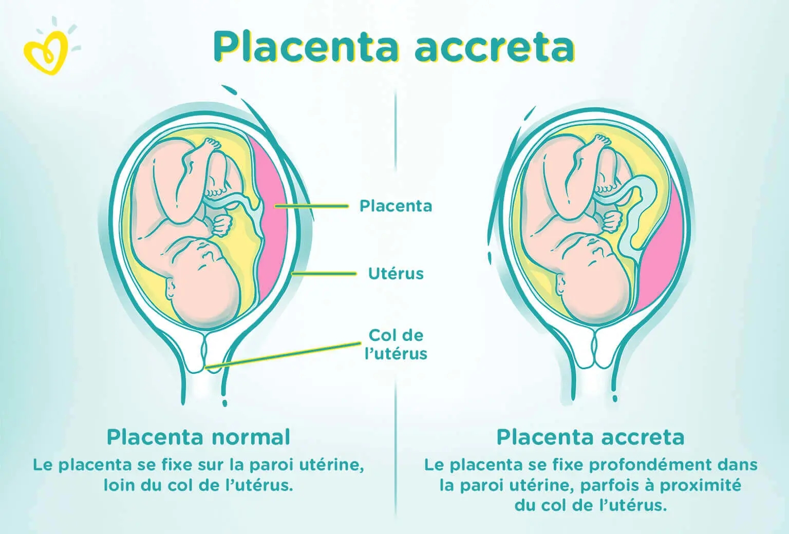 Placenta Accreta Symptomes Causes Et Risques Pampers