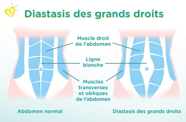 Diastasis Des Grands Droits Pendant Et Apres La Grossesse Pampers