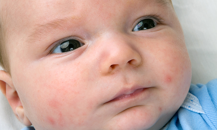 Acné du nourrisson: symptômes et traitement | Pampers FR