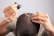 Oral Minoxidil For Hair Loss Benefits Uses And Side Effects