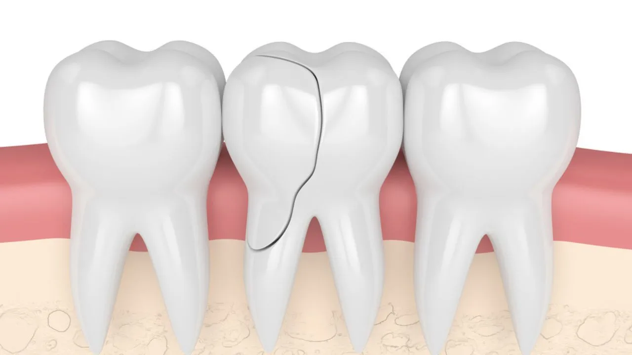 Dentes trincados: um problema silencioso