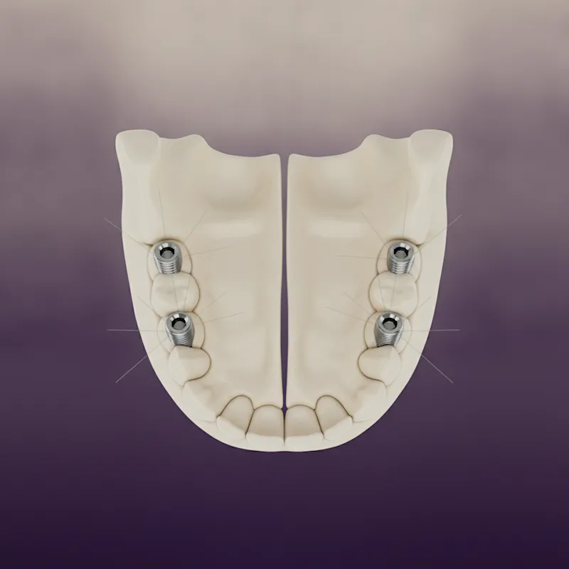 Posicionamento de implantes para overdenture mandibular