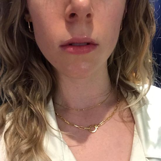 What It's Really Like To Get Lip Fillers