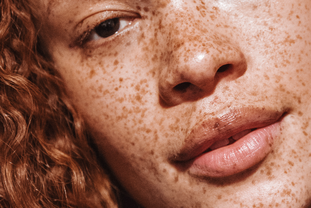 freckles on face