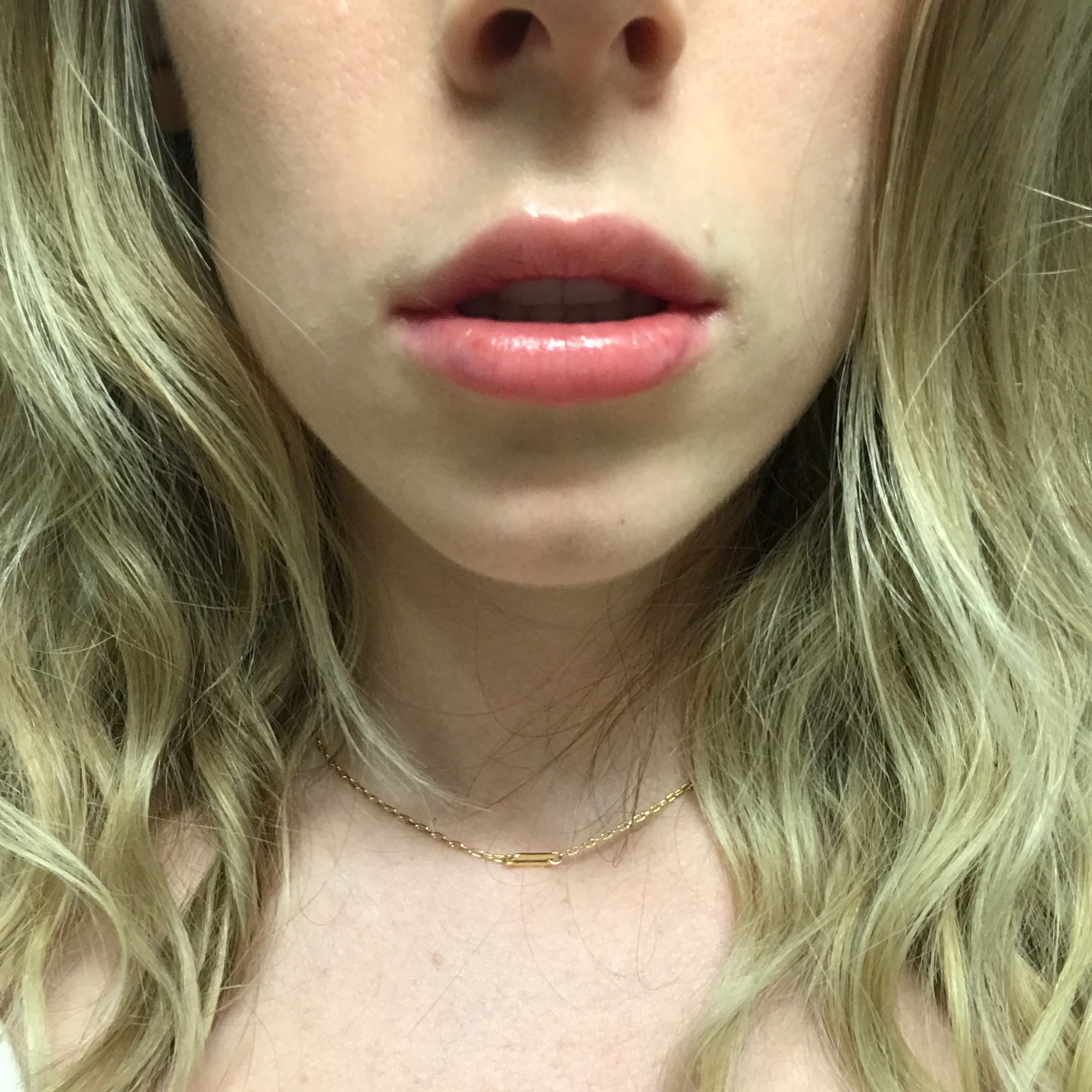 Exactly What To Expect From Lip Fillers