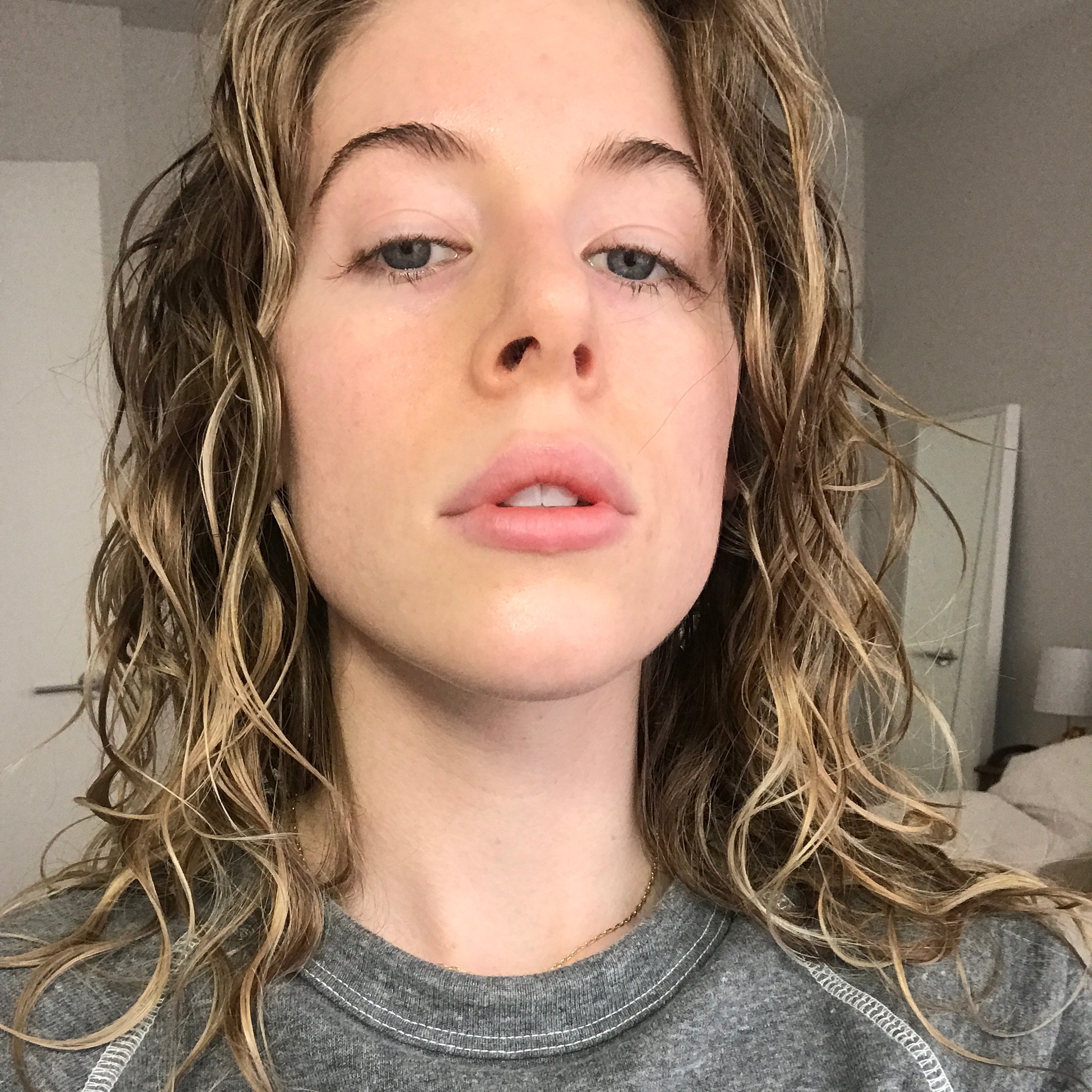 What It's Really Like To Get Lip Fillers