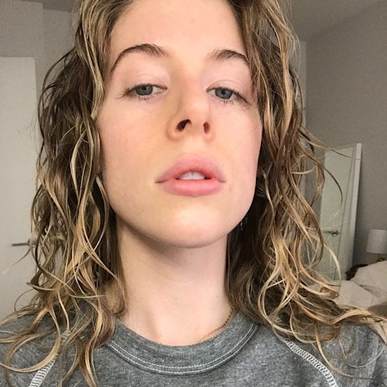 What It's Really Like To Get Lip Fillers