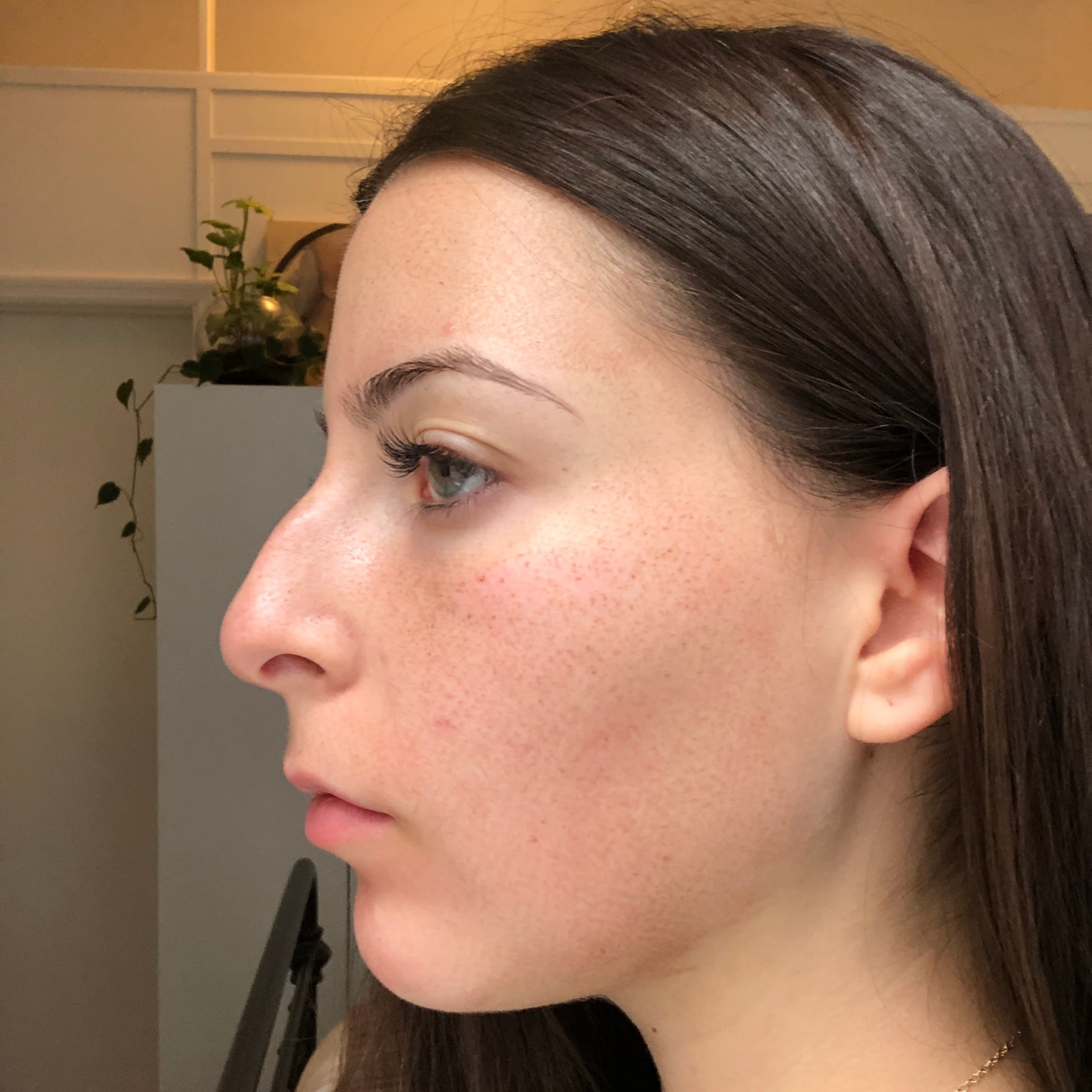 What To Expect When You Laser Away Your Acne Scars 