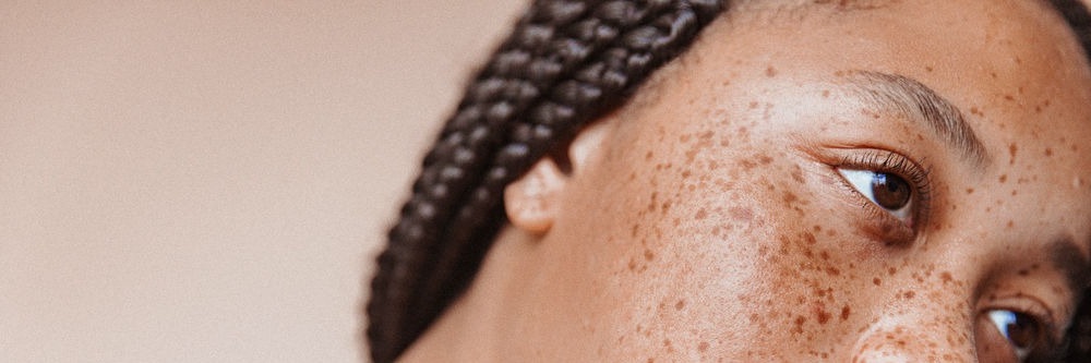 I Loved My Freckles, Then I Lasered Them Off