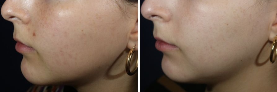 This Is My Face After Fraxel