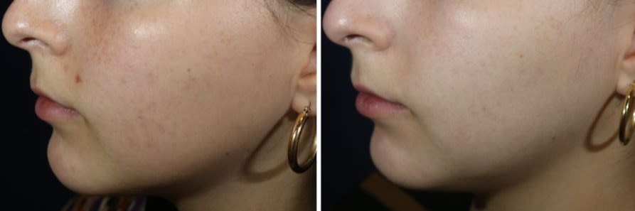 This Is My Face After Fraxel