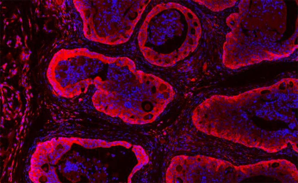 Prostate cancer cells