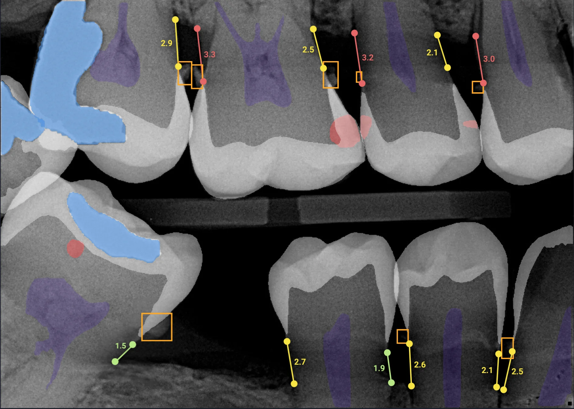 All findings with Overjet x-rays