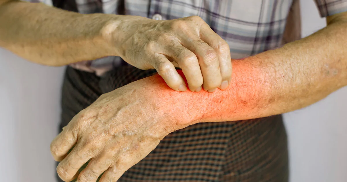 Managing Skin Issues in Liver Disease