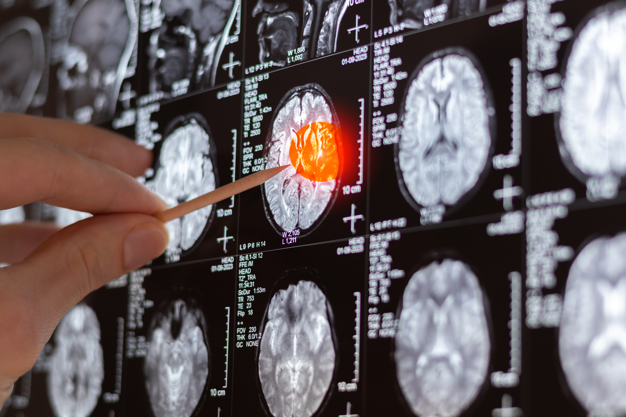 How Encephalitis Is Diagnosed: Tests and Procedures Explained