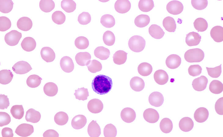 What Is Monoclonal B-cell Lymphocytosis (MBL)?