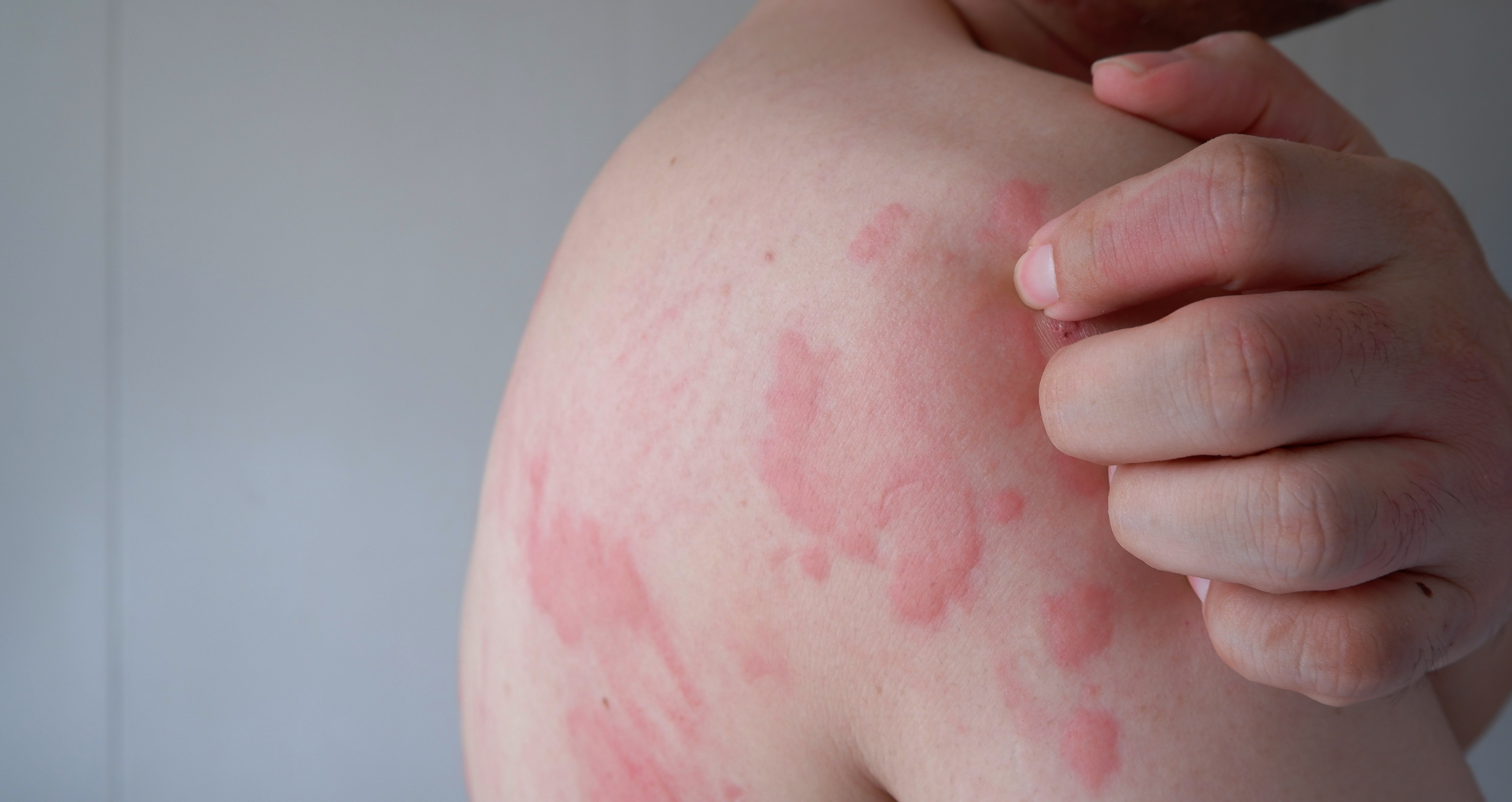 Chronic Spontaneous Urticaria: Why It Happens and What We Know