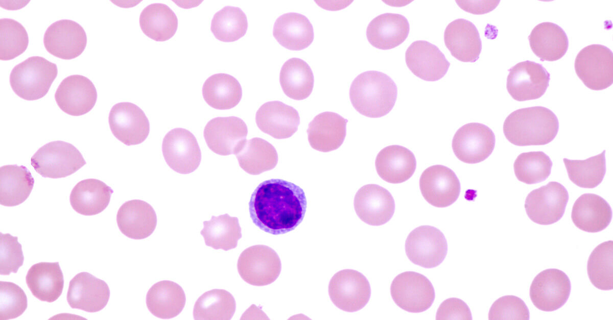 What Is Monoclonal B-cell Lymphocytosis (MBL)?