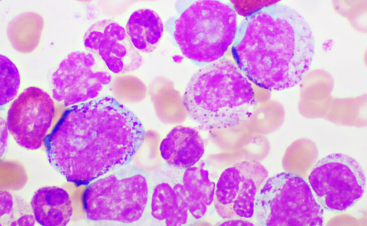 What Is chronic myeloid leukemia?