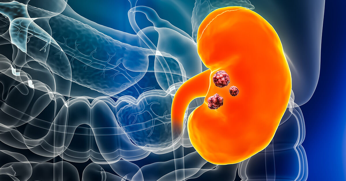 Rare kidney cancers Statistics, treatments, and patient stories