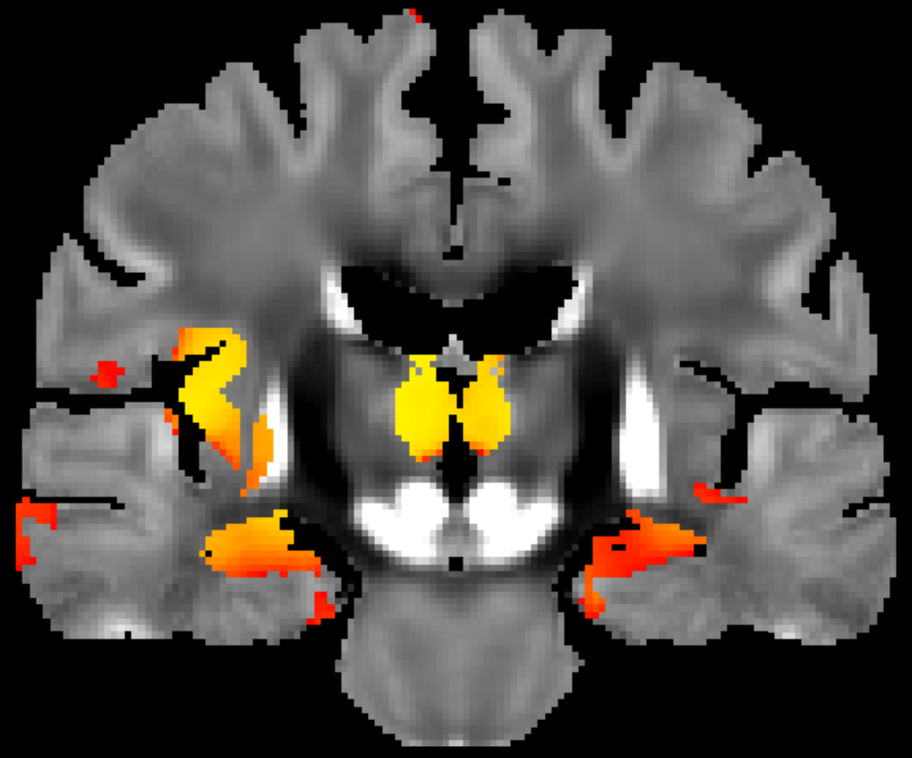 Iron brain image
