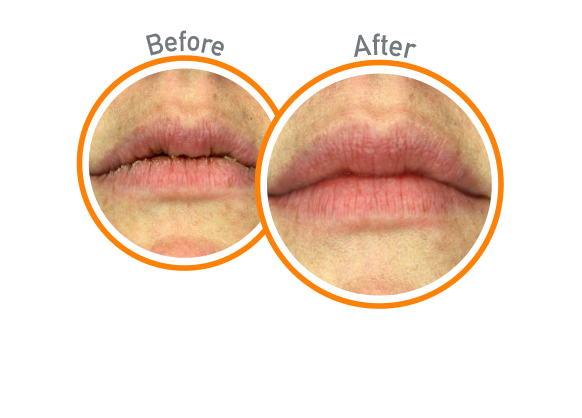 Lip Repair - Before and After Use - Guaranteed Relief for Extremely Dry, Cracked Lips