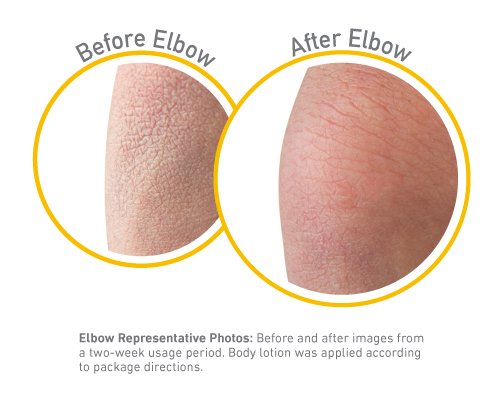 Skin Repair - Before and After Use - Guaranteed Relief for Extremely Dry, Itchy Skin