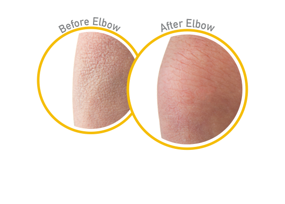 Skin Repair - Before and After Use - Guaranteed Relief for Extremely Dry, Itchy Skin