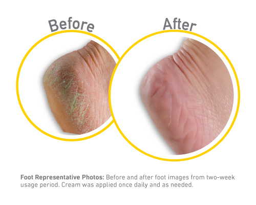 Healthy Feet  Exfoliating - Before and After Use - Guaranteed Relief for Extremely Dry, Cracked Feet