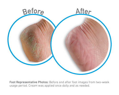 Healthy Feet - Before and After Use - Guaranteed Relief for Extremely Dry, Cracked Feet