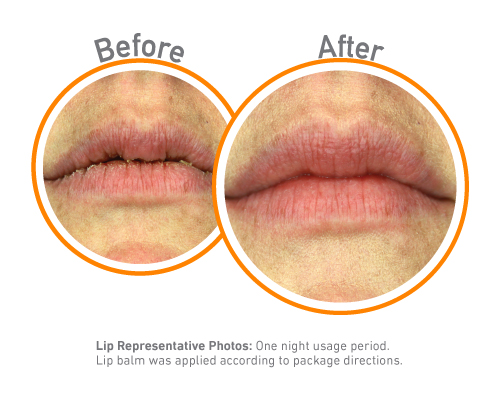 Lip Relief Night Treatment - Before and After Use - Guaranteed Relief for Extremely Dry, Cracked Lips