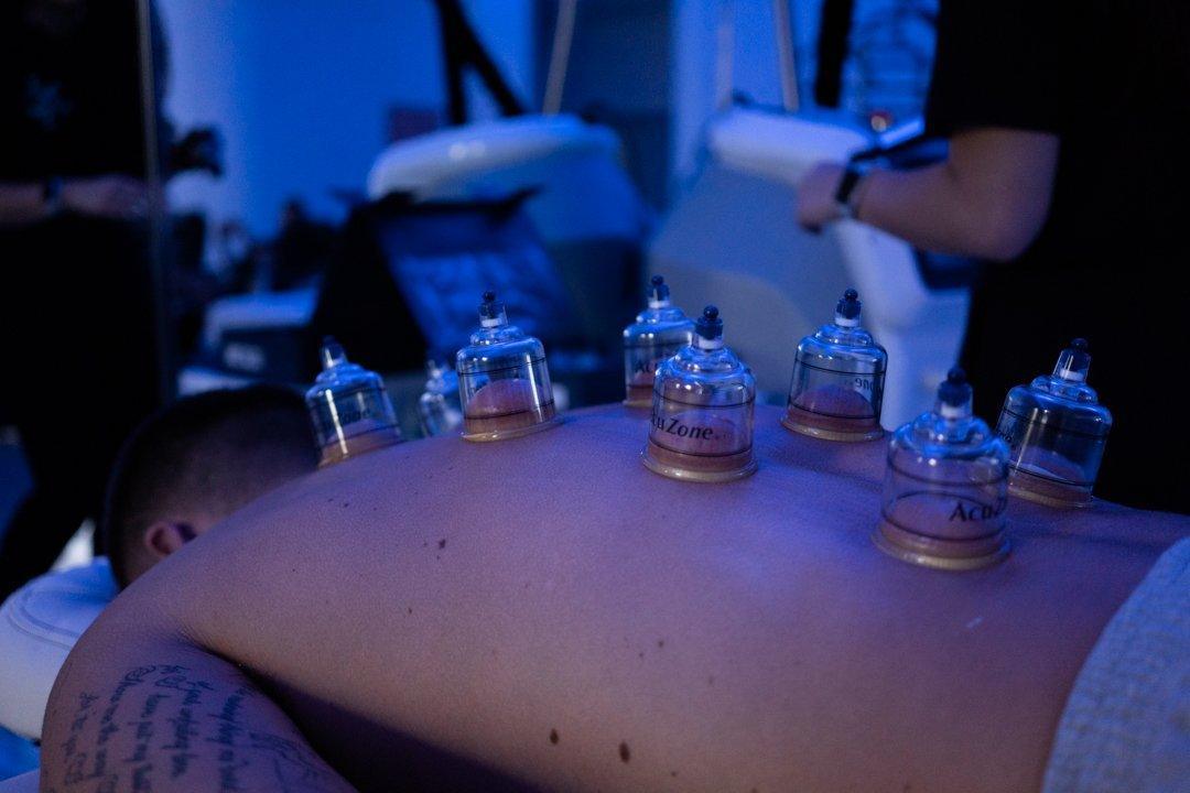 Signs You Should Give Cupping Therapy a Try