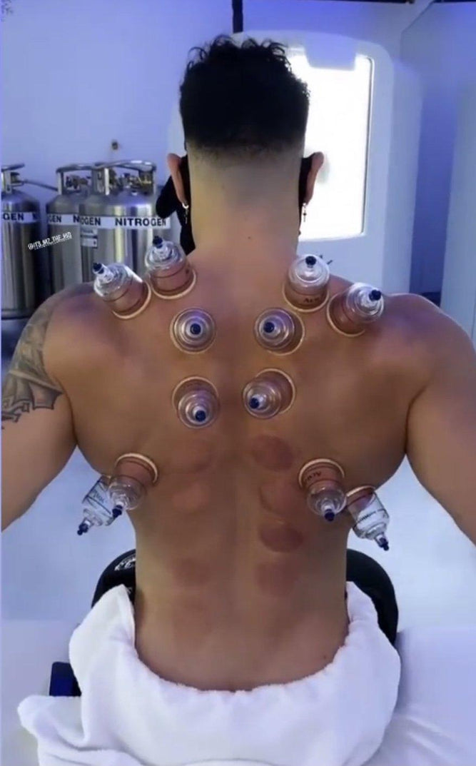 Cupping Massage: An Overview, What to Expect, and Handy Tips