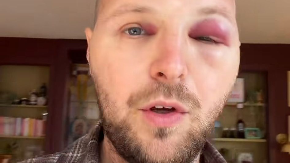 Tim Senders schrikt van uiterlijk na haartransplantatie: 'Is geen filter' | Shownieuws