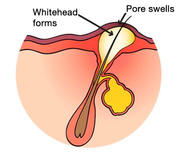 white head formation 