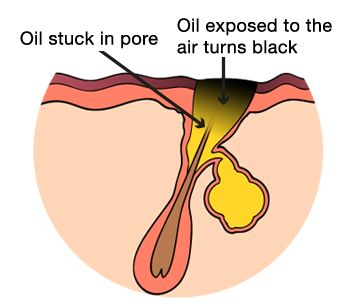 blackhead 