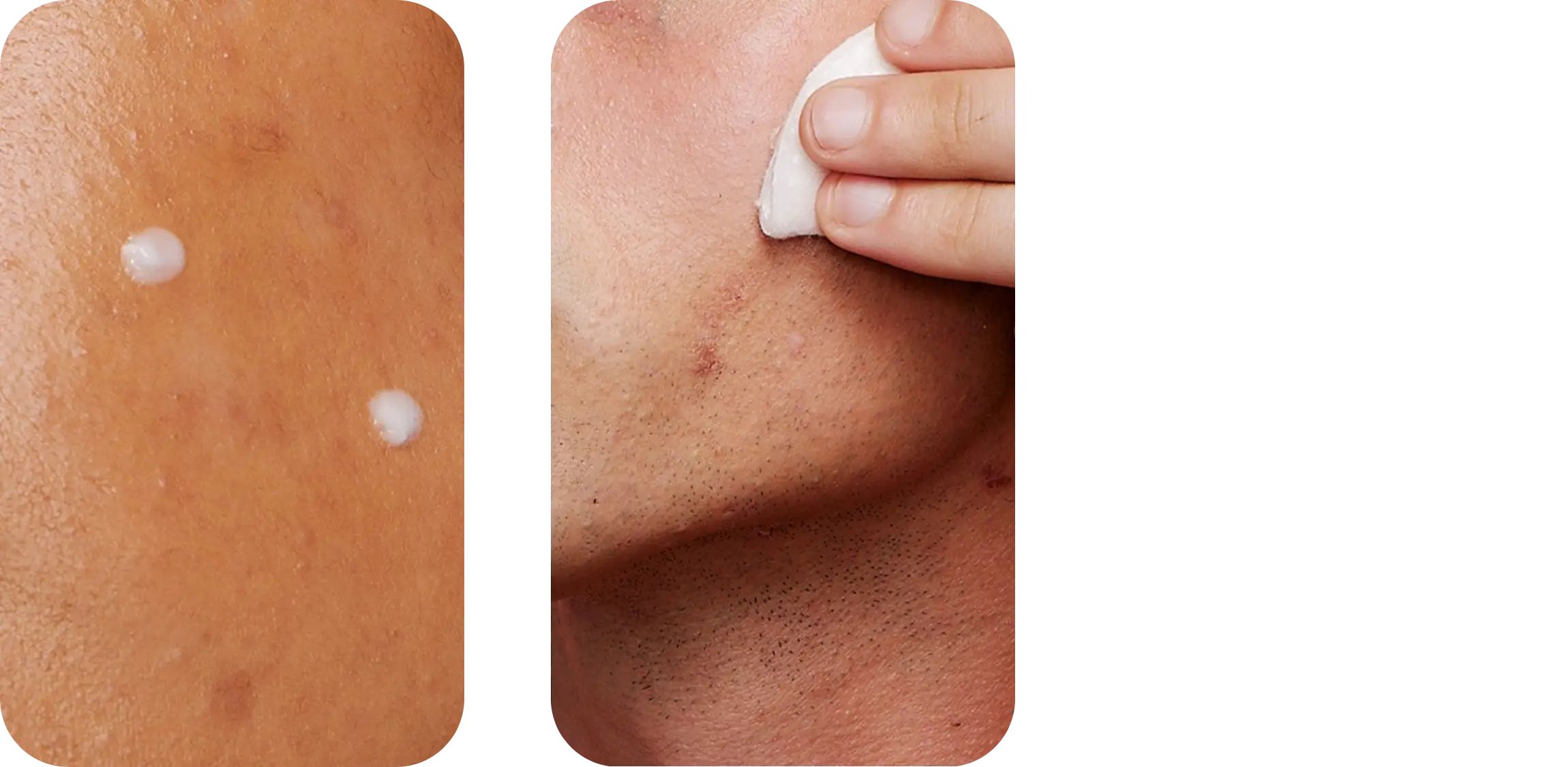 Left side shows two white cream dots on brown skin; right side features a hand applying a white pad on facial skin, suggesting a skincare routine. Black background.