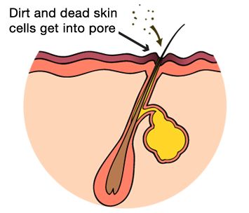 blackhead pore