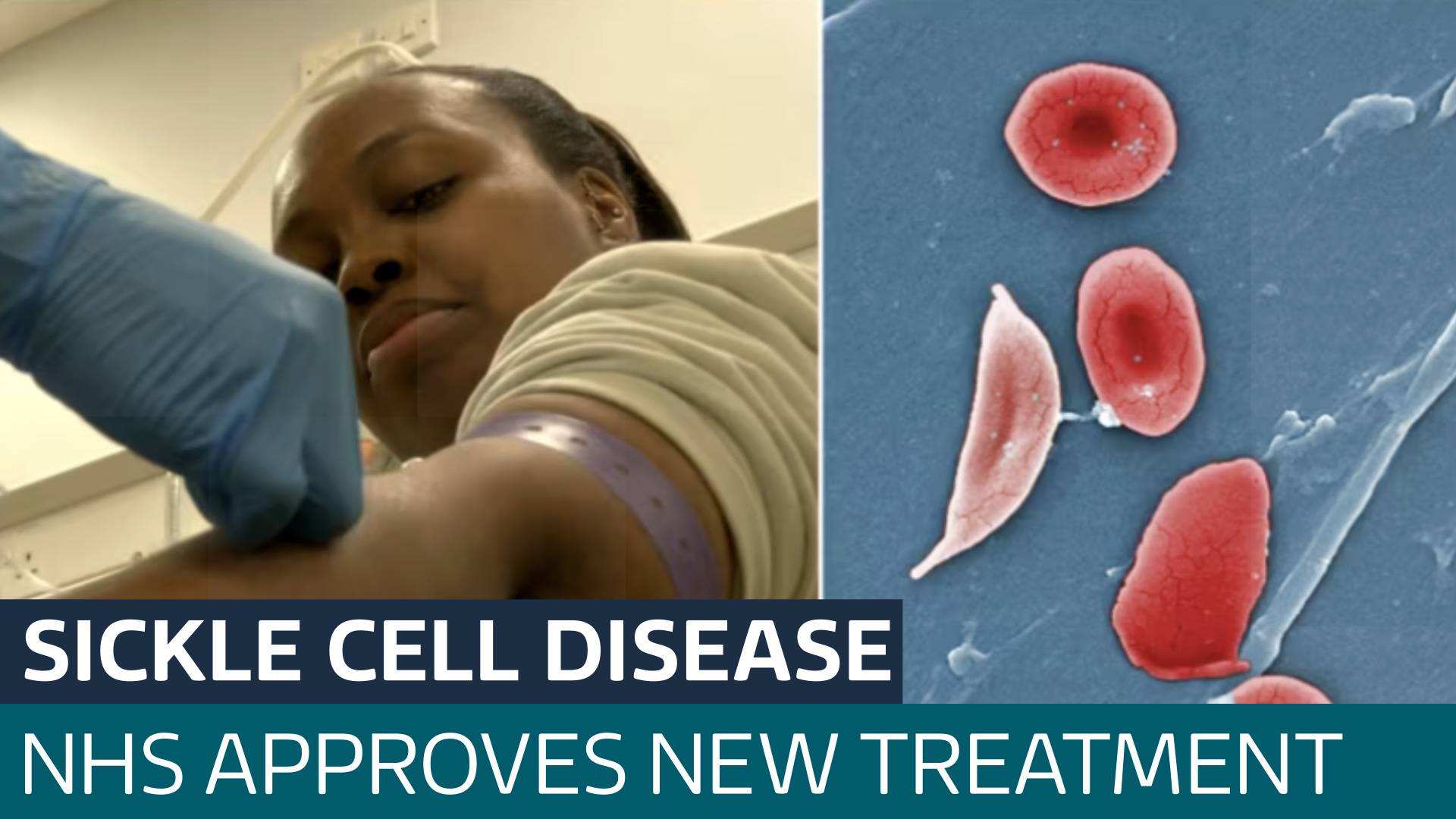 How A New Nhs Treatment For Sickle Cell Disease Could Offer Patients 